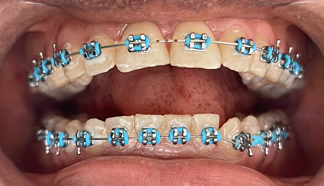 After braces — Case 01