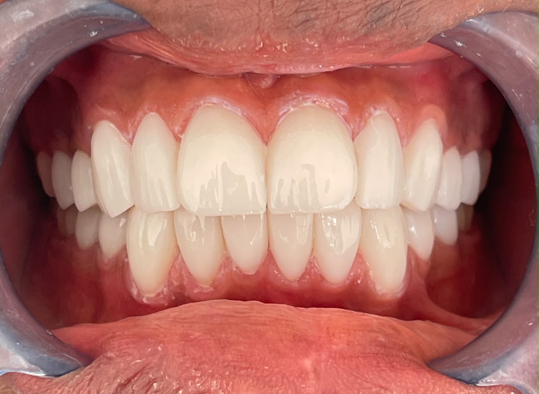 After veneers — Case 02