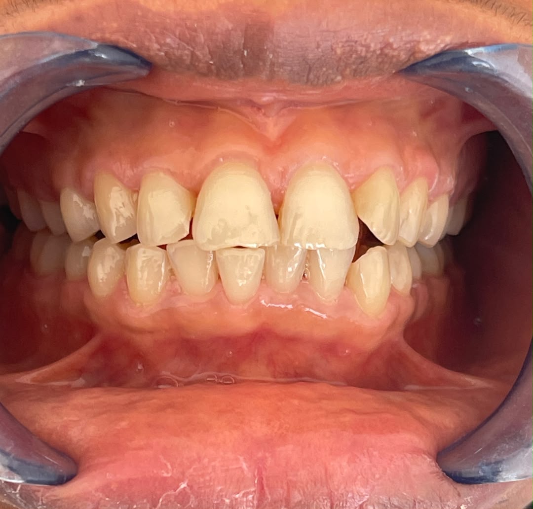 Before braces — Case 01