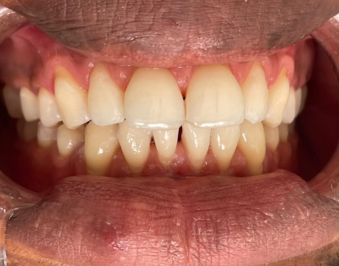 Before veneers — Case 02