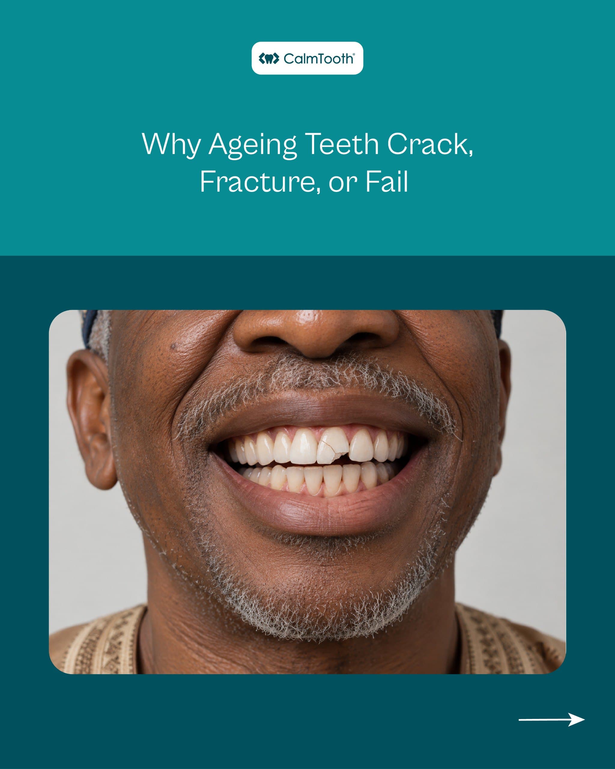 Why Ageing Teeth Crack, Fracture, or Fail (and How to Protect Them)